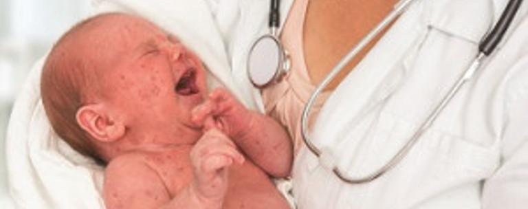 Measles Istock Resized 2019