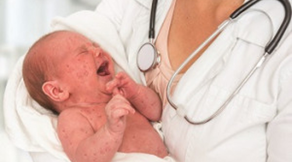 Measles Istock Resized 2019